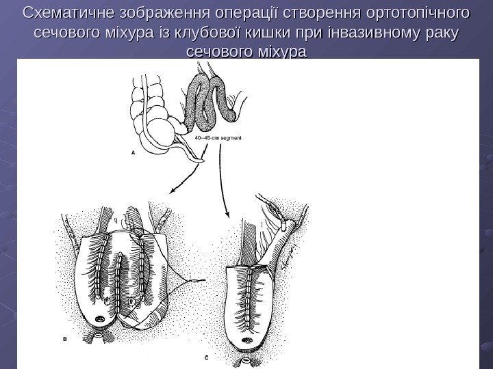   Схематичне зображення операції створення ортотопічного сечового міхура із клубової кишки при інвазивному